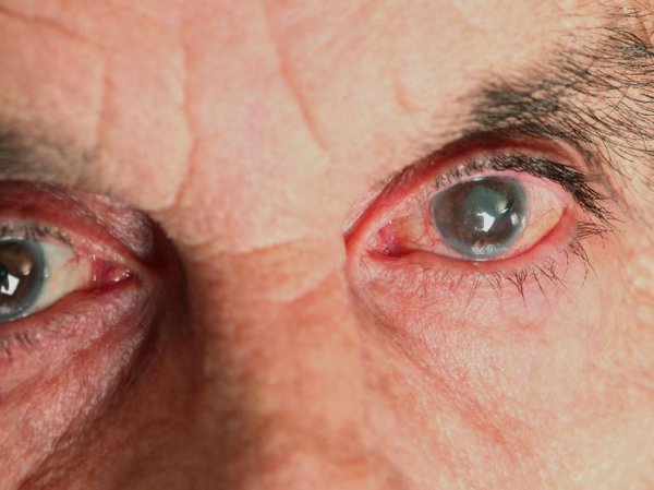 Врач рассказал об основных способах профилактики глаукомы и борьбы с ней